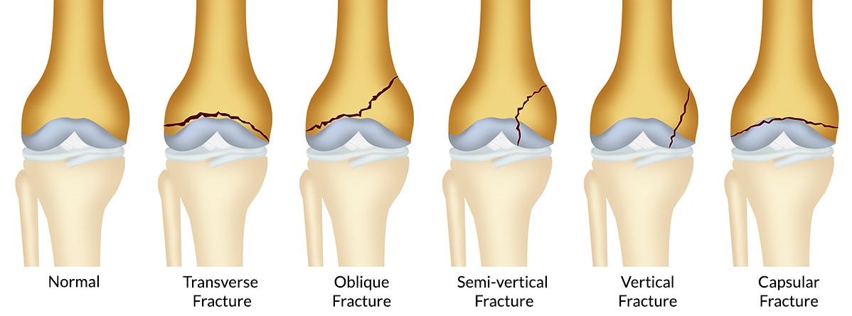 knee fractures