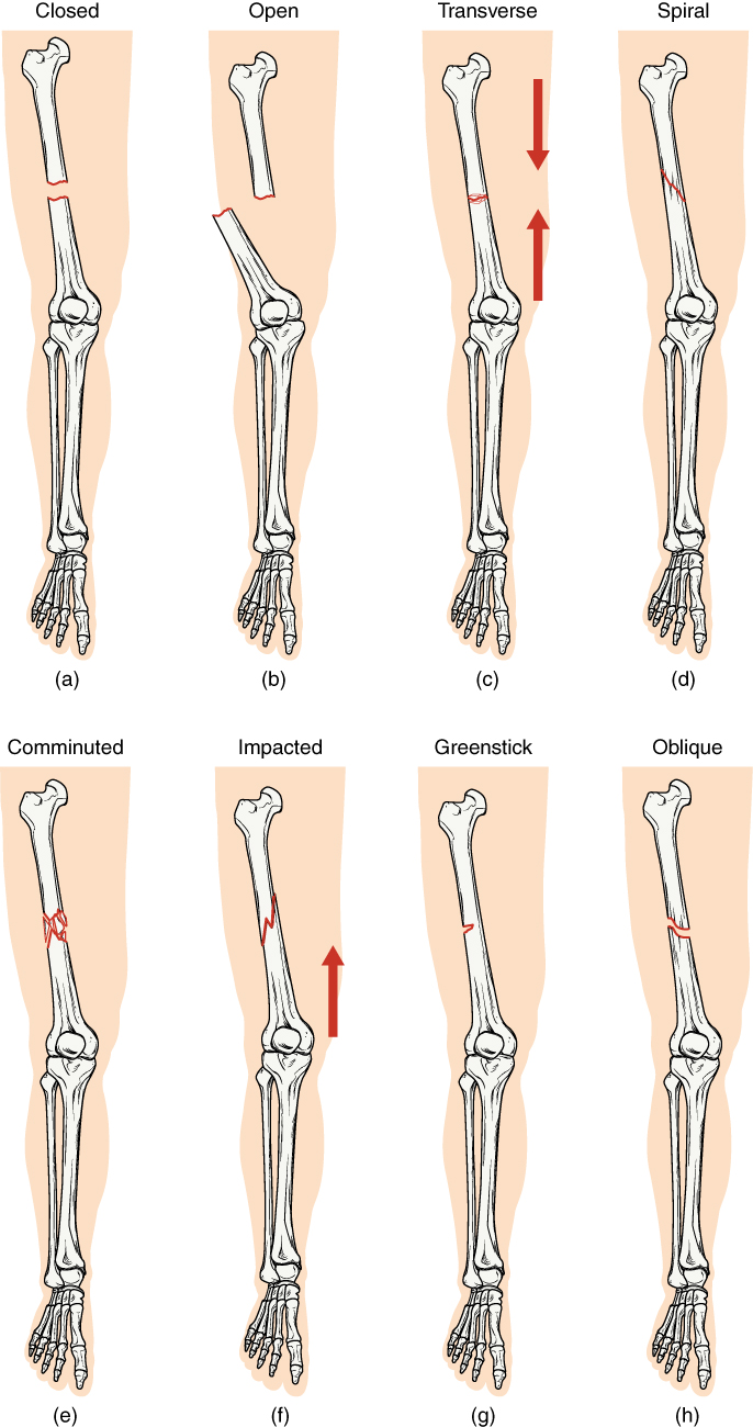 types on bone fractures